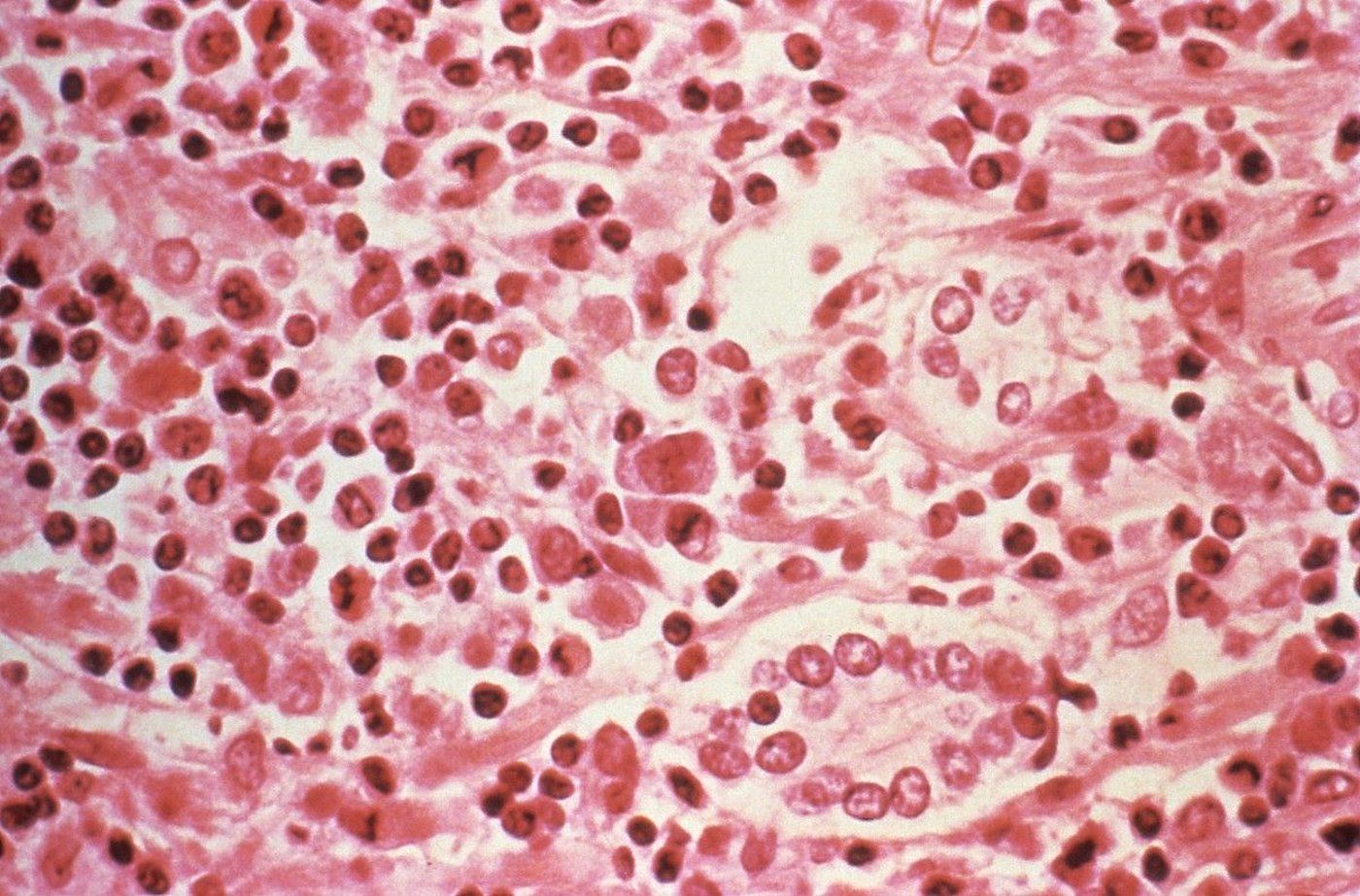 Hantavirus kills three in Venezuela